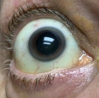 bulging eyeballs disease
