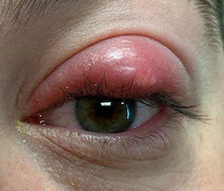 Expert suggested ways to prevent eye pimple or stye