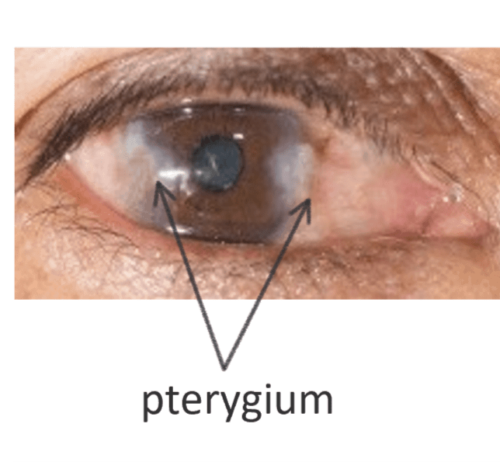 Pinguecula and Pterygium (sometimes called “Surfer’s eye”) – Ask Eye Doc